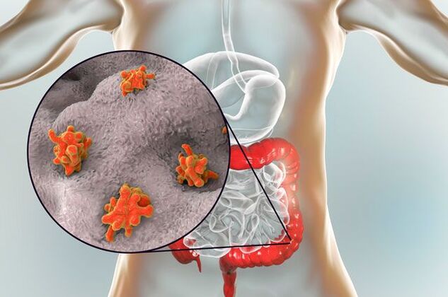 Parazītu veidi cilvēka ķermenī